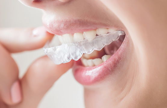 Woman Putting on Invisalign Clear Aligners